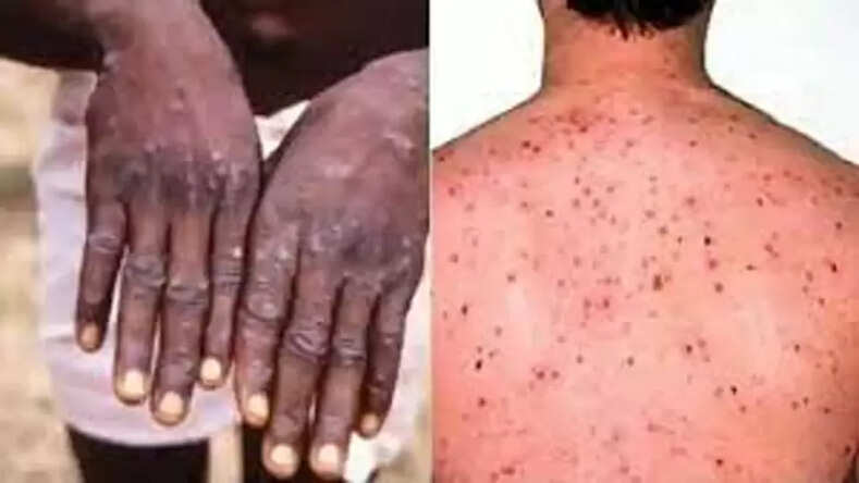 केरल में Monkeypox का 5वां मामला आया सामने, देशभर में 7 मामले