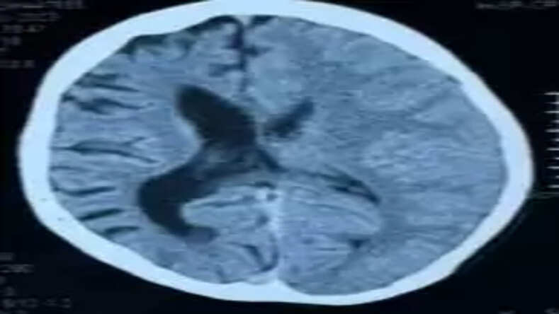  Shahjahanpur: कम उम्र में गंभीर बीमारी, 15 साल के किशोर में रेयर न्यूरोलॉजिकल डिसऑर्डर का खुलासा